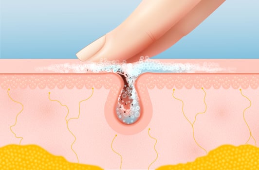 Skin pore cleaning realistic cross-section vector