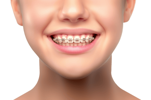 Smile With Teeth Braces for Dentist Advertisement Isolated on Transparent Background png