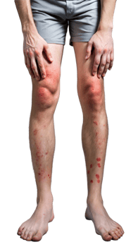Person with skin allergies on legs showing irritation on transparent background png
