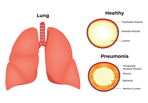 Lung Healthy Pneumonia Science Design Illustration Diagram vector