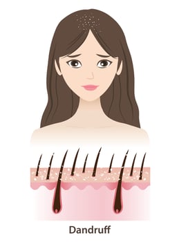 The woman with dandruff on hair illustration isolated on white background. Cross section of white dry flakes, scaly patches on scalp layer. Hair care and problem concept. vector