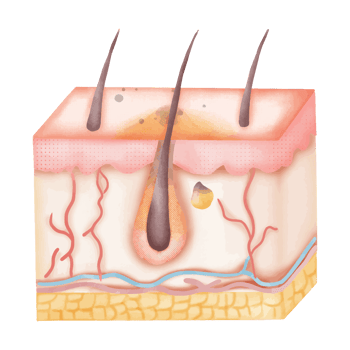 Watercolor illustration of human skin with acne png