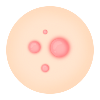 Acne Care Illustration, Skin with Acne Issues, Acne Types Clipart png