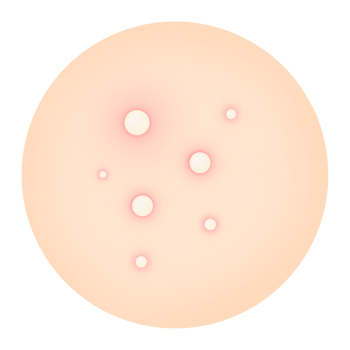 Acne Care Illustration, Skin with Acne Issues, Acne Types Clipart png