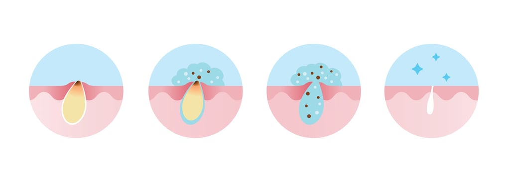 Step of acne pimple treatment process icon set illustration. Apply salicylic acid on blackhead, penetrate into skin to dissolve the dead skin cells clogging pore and keeping pores clear. vector