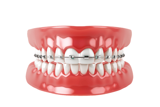 Dentures with braces, isolated against a transparent background png