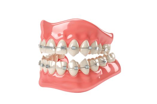 Dentures with braces, isolated against a transparent background png