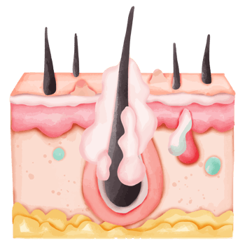 Watercolor Illustration of a Hair Follicle with Sebaceous Gland Infection png