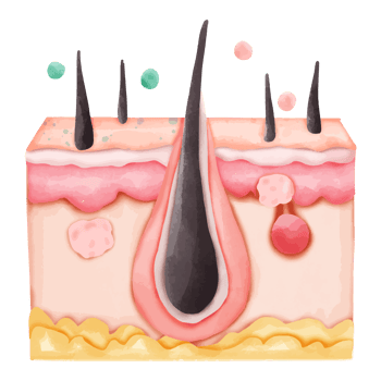 Watercolor Illustration of Hair Follicle with Clogged Pore and Pimples png