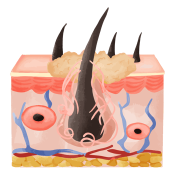 Watercolor Illustration of Hair Follicle with Deep Sebum Accumulation png