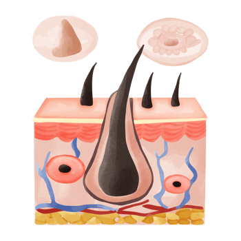 Watercolor Illustration of Hair Follicle with Follicular Hyperkeratosis png