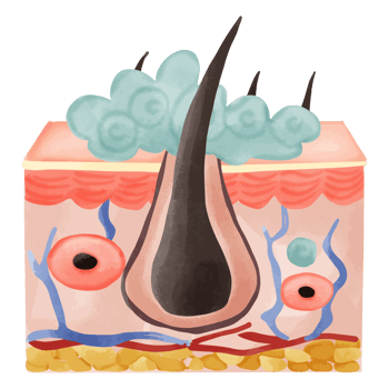 Watercolor Illustration of a Hair Follicle with Sebaceous Hyperplasia png