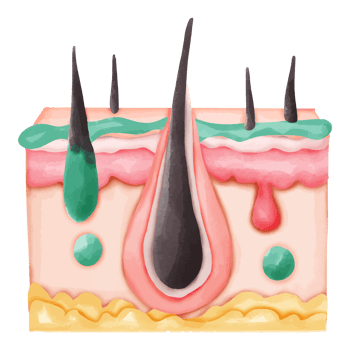 Watercolor Illustration of Hair Follicle with Sebum and Pus png