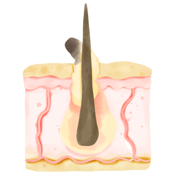 Watercolor Illustration of Hair Follicle with Sebum Buildup and Acne png
