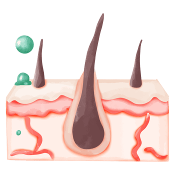 Watercolor Illustration of Hair Follicle with Bacterial Infection png