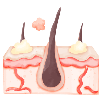 Watercolor Illustration of Hair Follicle with Sebum Build-up png