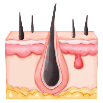 Watercolor Illustration of an Inflamed Hair Follicle with Sebaceous Cyst png