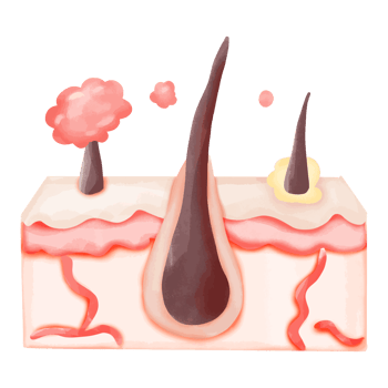 Watercolor Illustration of Hair Follicle with Ingrown Hair and Sebum Build-up png