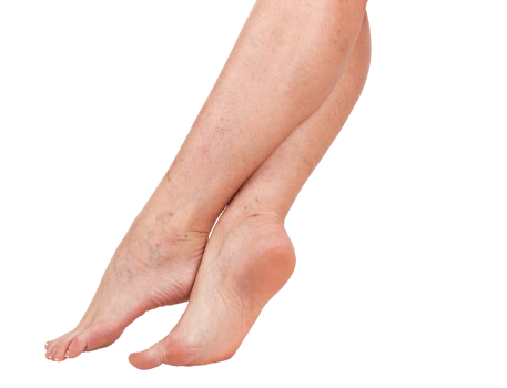 Legs of a woman. Skin with vascular stars. png