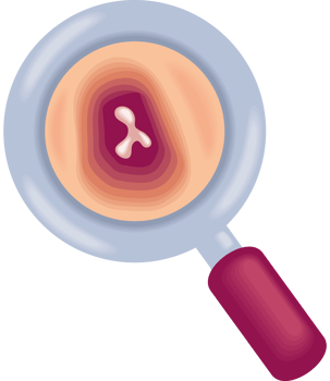 multiple myeloma bone marrow cancer png