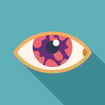 Bloodshot eye showing glaucoma or conjunctivitis illustration vector