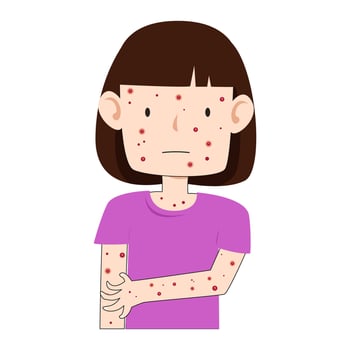 chicken pox virus infection disease vector