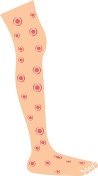 Rashes on the Leg Illustration vector