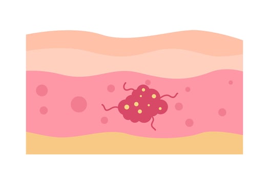 cancer tumor disease concept vector