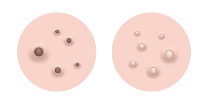 Blackheads and whiteheads Acne skin pimple, illustration vector