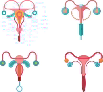 hormonal IUD set design vector