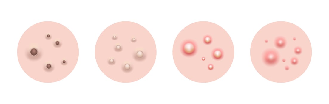 Acne skin pimple, illustration vector