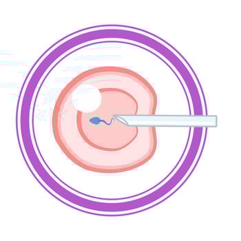 In Vitro fertilization IVF infographic and infertility treatment scheme. Ovarian hyperstimulation, artificial insemination, embryo culture and cryopreservation. Medical procedure for pregnancy vector