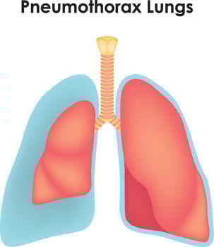 Pneumothorax Lungs Illustration vector