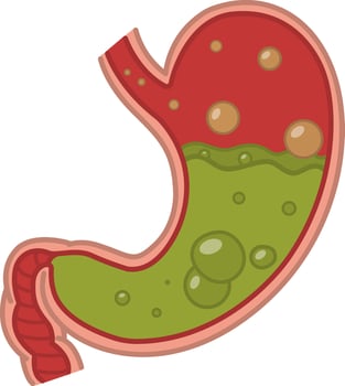 Stomach disease. The Human Stomach is Full of Stomach Acid. Nausea, Belching, Acid Reflux. Anatomy and Medicine vector