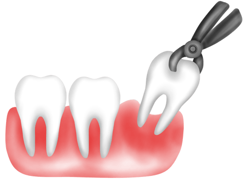 Tooth extraction with forceps png