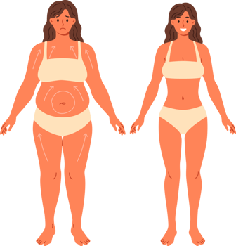 Liposuction for overweight woman posing in underwear before and after surgery. Beautiful girl in need of liposuction demonstrates progress achieved without use of diets and fitness png