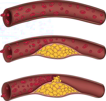 illustration of clogged arteries stage vector