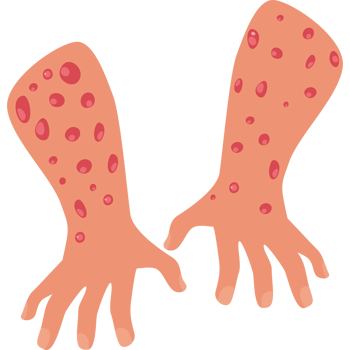 human hands with monkeypox virus png