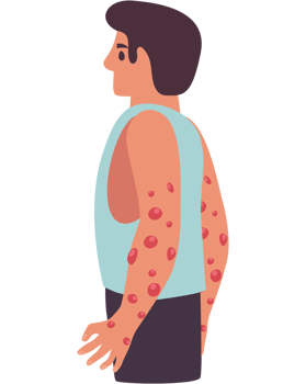 patient with monkey pox disease png