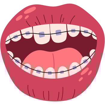 Braces on the teeth. Open mouth with braces. Healthy lifestyle and dental care. vector
