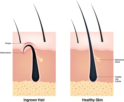 Ingrown Hair and Healthy Skin Science Design Illustration Diagram vector