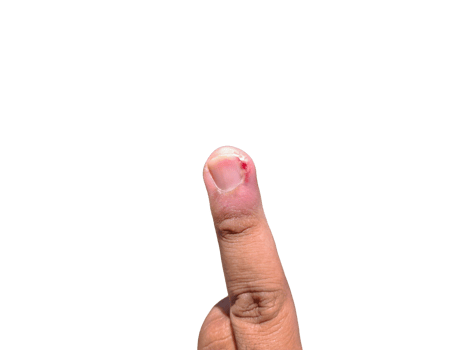 middle finger injured by an ingrown toenail png