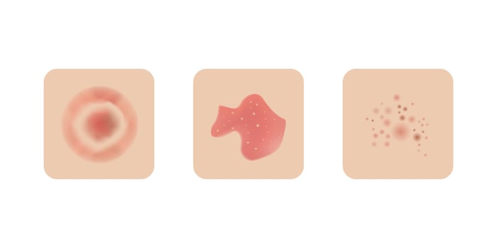 Skin allergy examples design, dermatology problems. Red rash and spots, itchy, swollen redness. vector