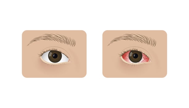 Realistic human healthy eye and with conjunctivitis Red dry eye syndrome, anatomy, health and allergies. vector
