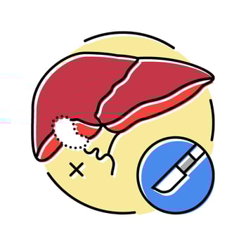 cholecystectomy surgery color icon illustration vector