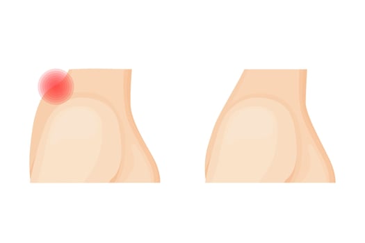 Cervical osteochondrosis medical care, before and after. Treatment hump on the neck. Orthopedics therapy vector