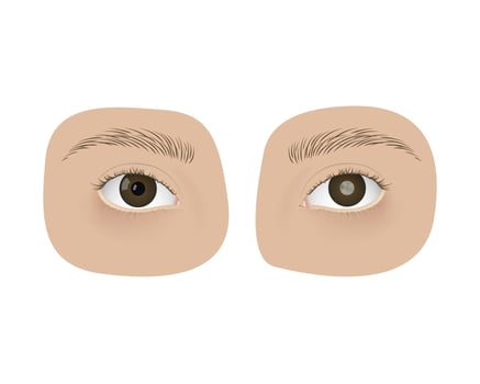 Realistic human healthy eye and with cataract. Disease, anatomy, health. vector