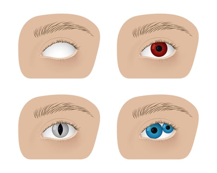 Realistic human healthy eye and with cataract. Disease, anatomy, health. vector