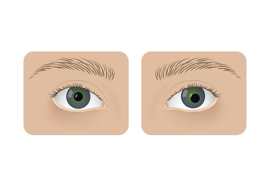 Realistic human normal eyes and with corectopia. Human sick, anatomy, health. vector