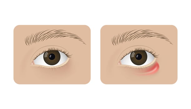 Realistic human healthy eye and with stye. Red inflammation, anatomy, health. vector